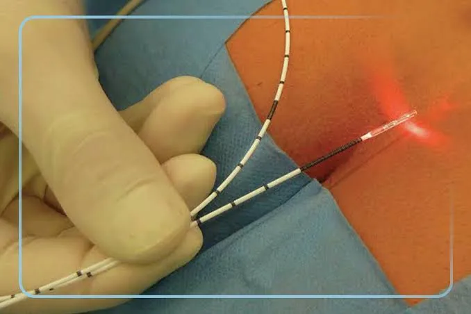 Fibra do laser de diodo posicionada sobre a pele da região sacrococcígea durante o tratamento do cisto pilonidal