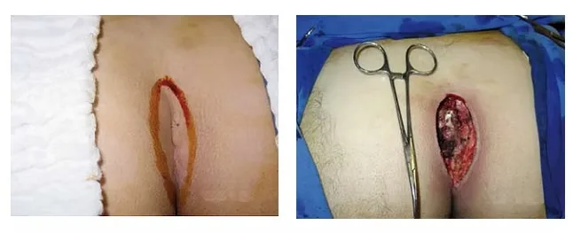 Foto de lesão aberta tradicional após cirurgia convencional de cisto pilonidal na região do coccix, com necessidade de curativos