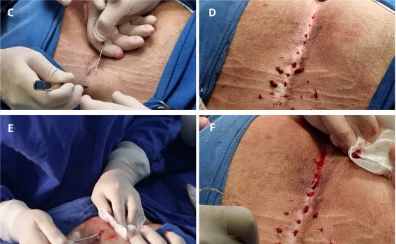 Fotos das etapas da cirurgia a laser de diodo para cisto pilonidal: acesso minimamente invasivo, destruição do trajeto e preservação dos tecidos saudáveis na região do cóccix