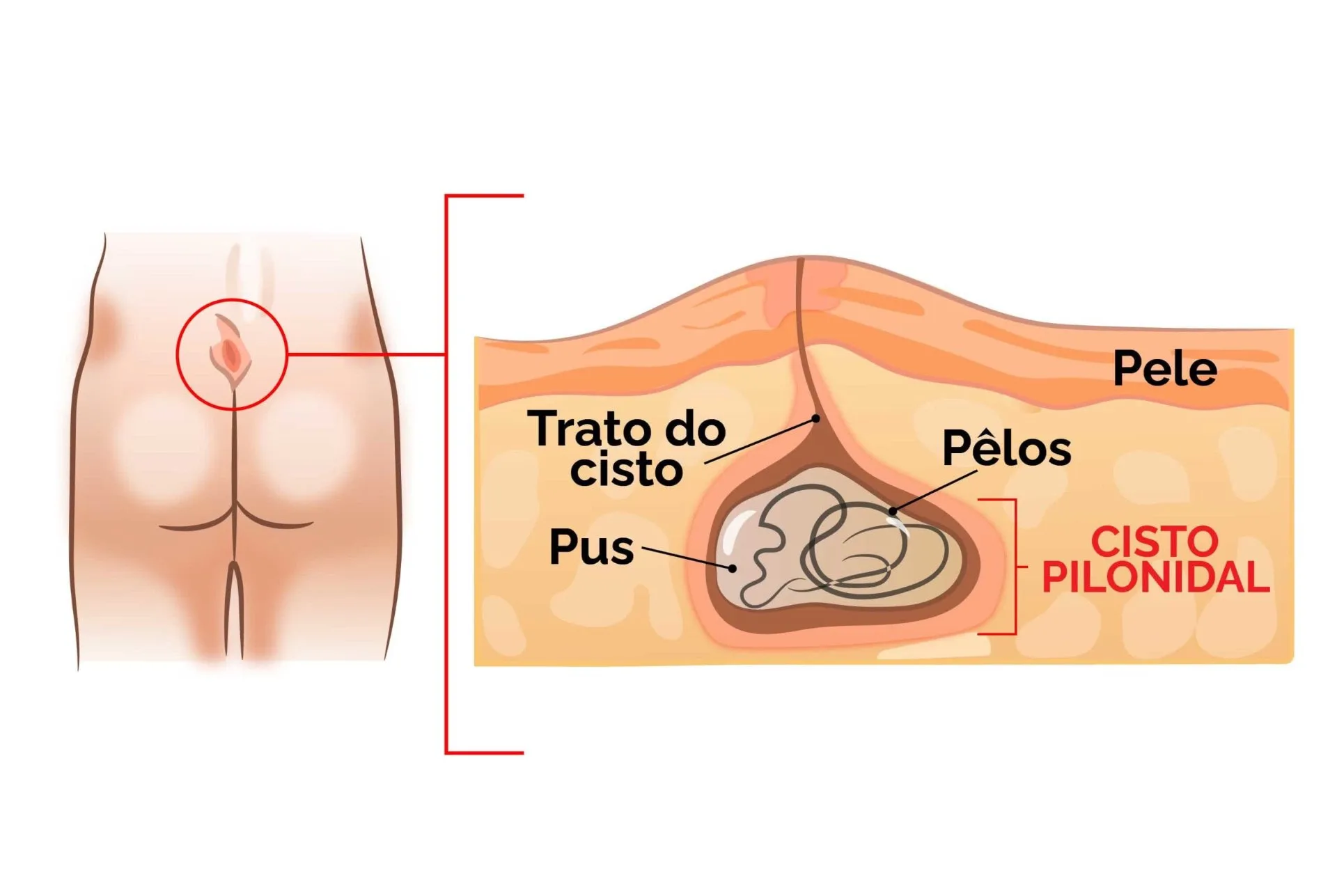 Imagem ilustrativa do cisto pilonidal na região sacrococcígea (cisto no coccix) mostrando pelos encravados, trajeto fistuloso e acúmulo de secreção